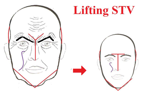 lifting stv